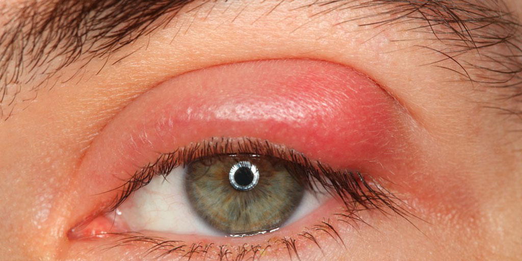 Eyelid Tumors Eyelid Tumors