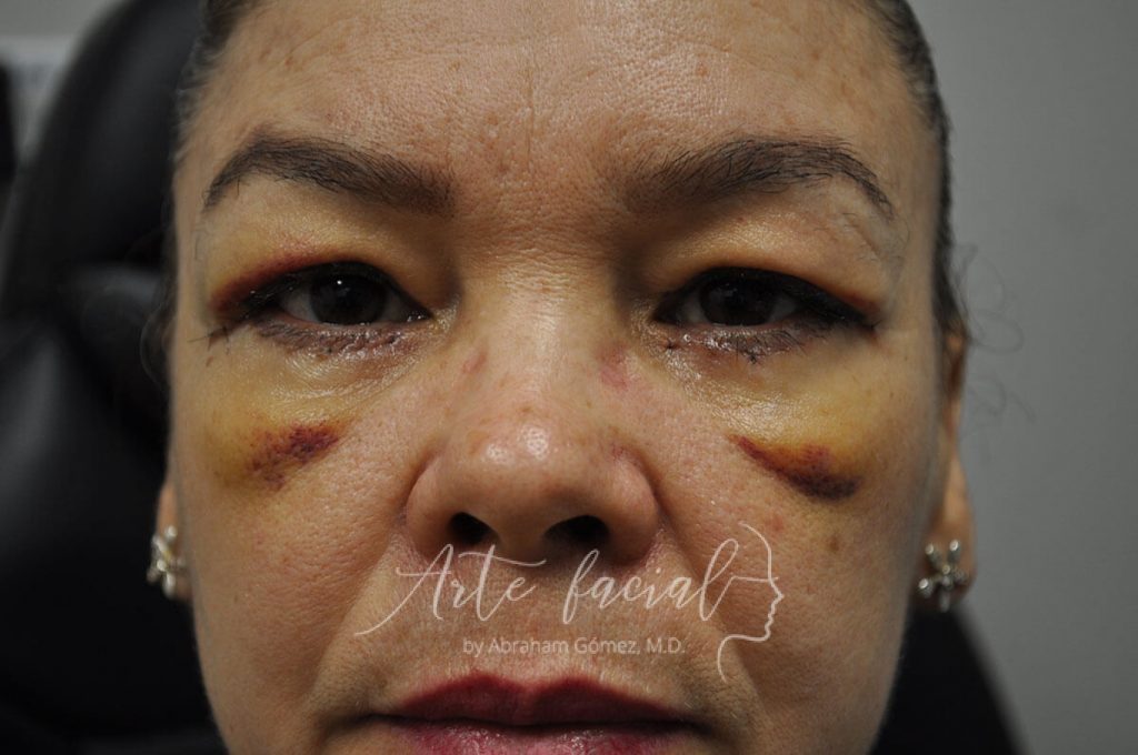 What to expect after plastic surgery to remove bags under the eyes