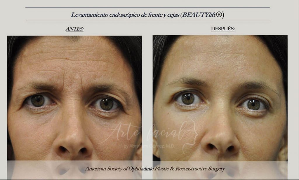 levantamiento-drente-cejas-botox