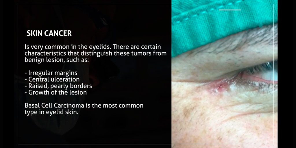 Skin-Cancer
