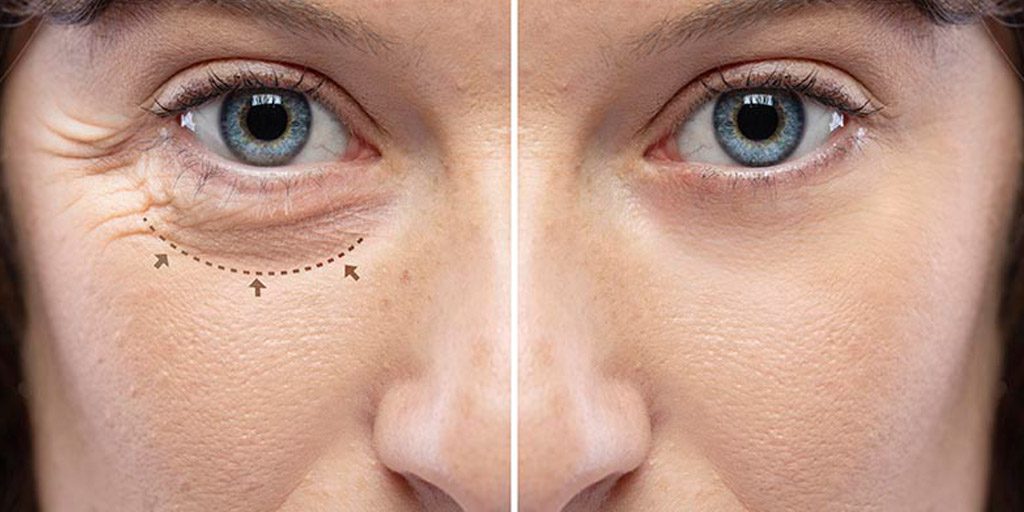 blefaroplastia-inferior-cr1