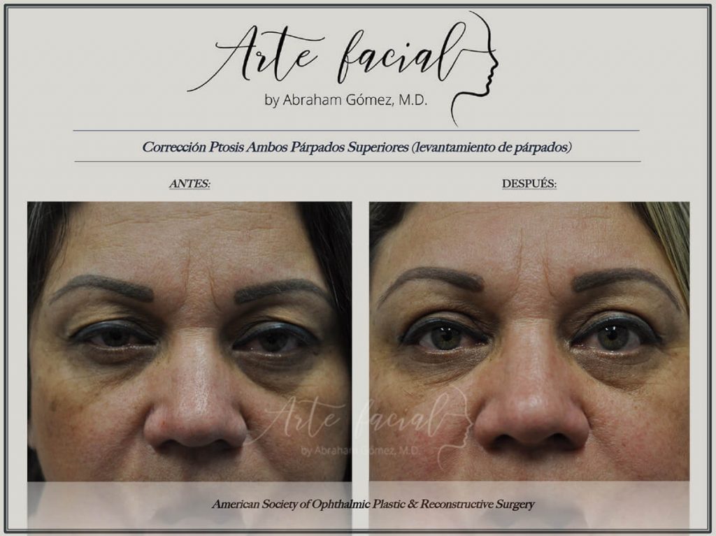 Upper eyelid lift