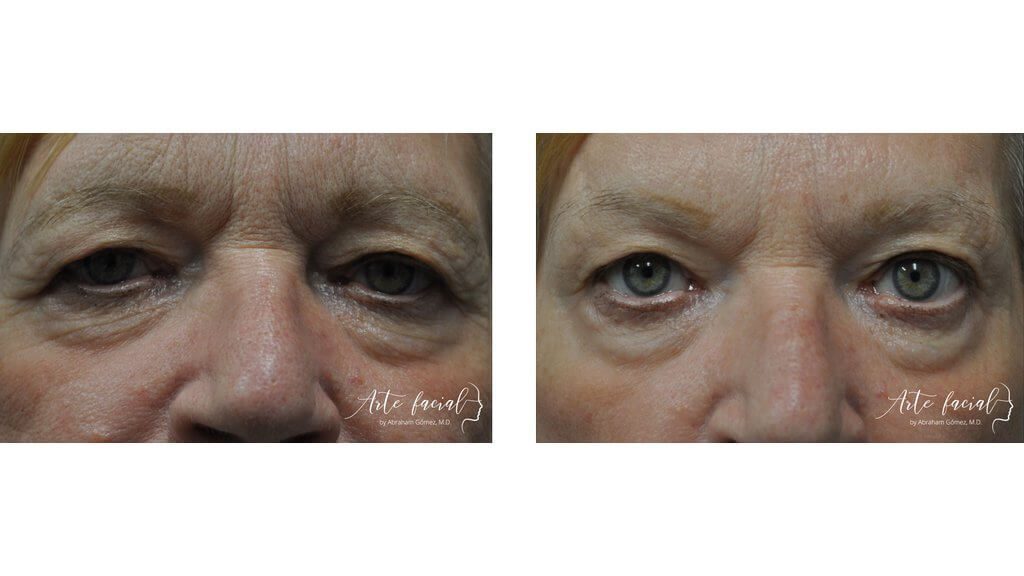 Non- surgical
