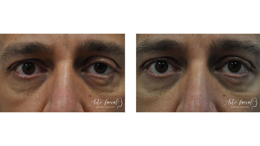 Antes y después (Ptosis)