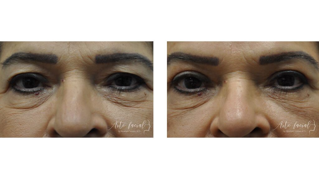 Eyebrows & upper eyelids
