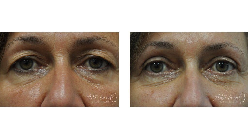 Eyebrows & upper eyelids