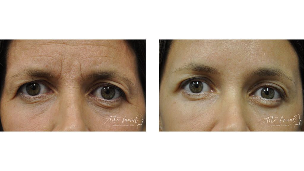 Eyebrows & upper eyelids
