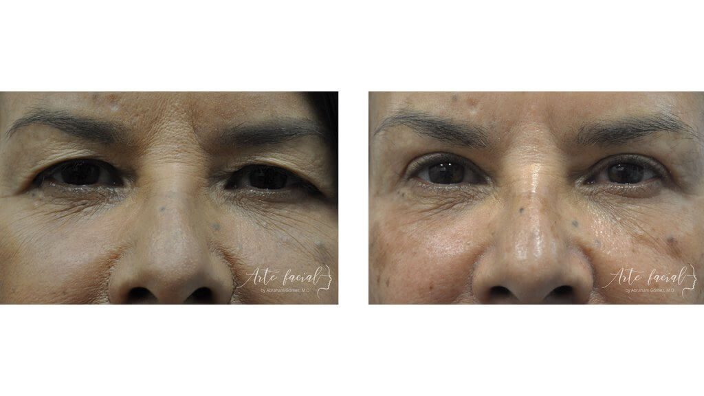 Eyebrows & upper eyelids