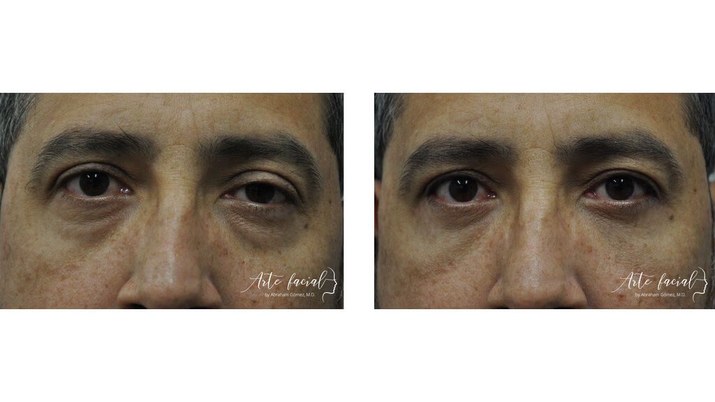 Droopy eyelid surgery
