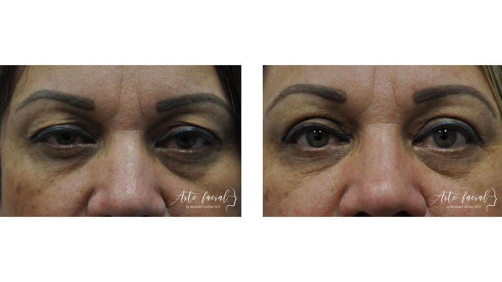 Droopy eyelid surgery