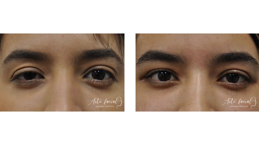 Droopy eyelid surgery