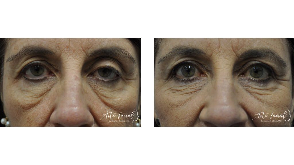 Droopy eyelid surgery