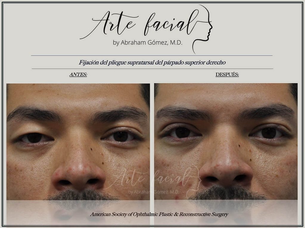 Droopy Eyelid Surgery - Ptosis