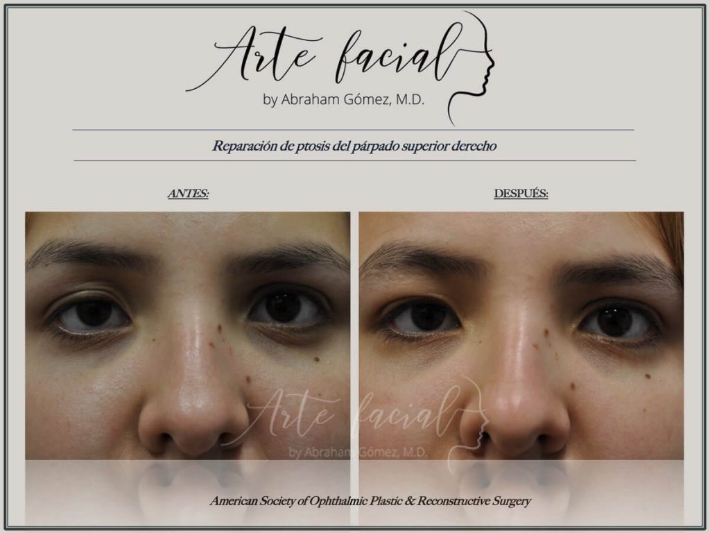 Droopy Eyelid Surgery - Ptosis