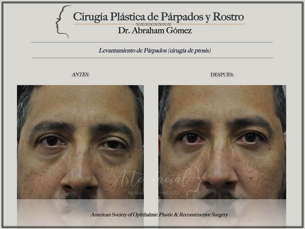 Droopy Eyelid Surgery - Ptosis