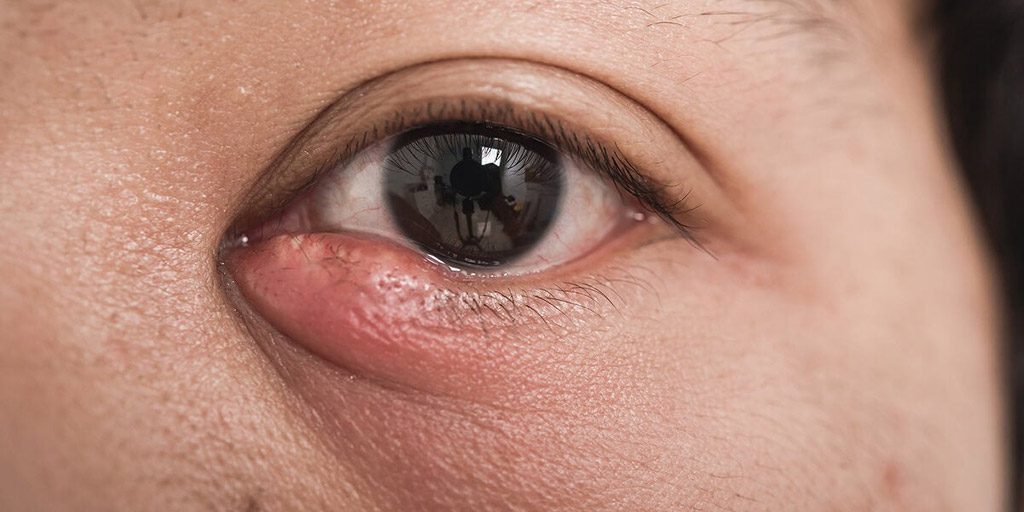 The Causes and Symptoms of a Tear Duct Obstruction The Causes and Symptoms of a Tear Duct Obstruction