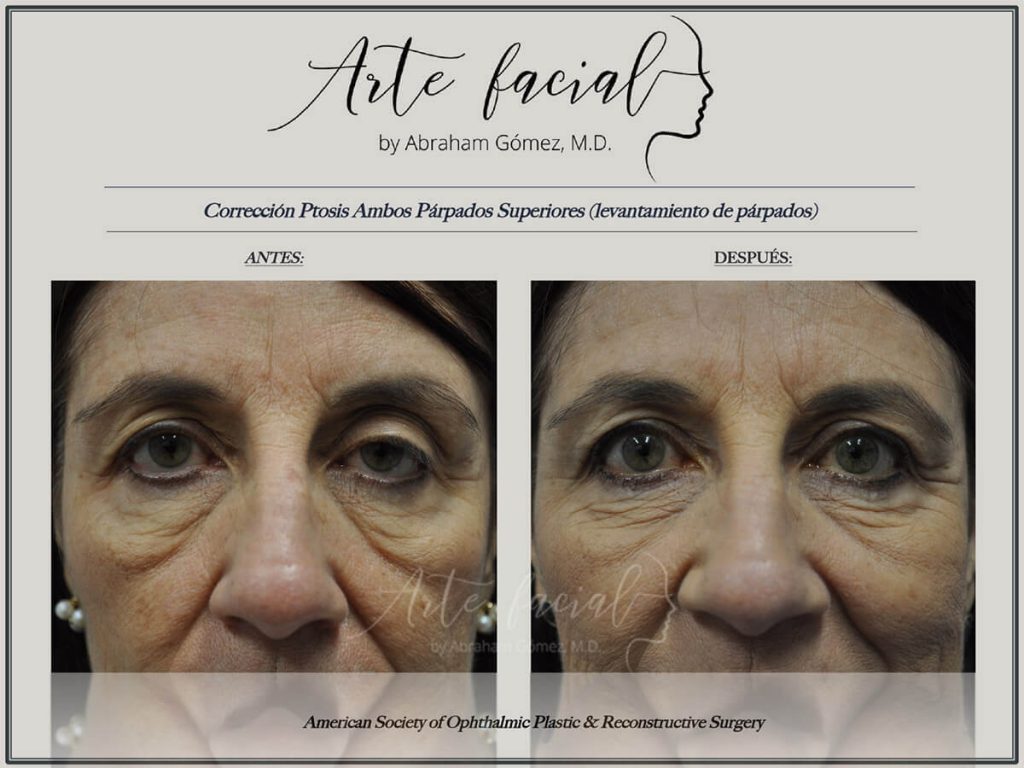 Droopy Eyelid Surgery - Ptosis