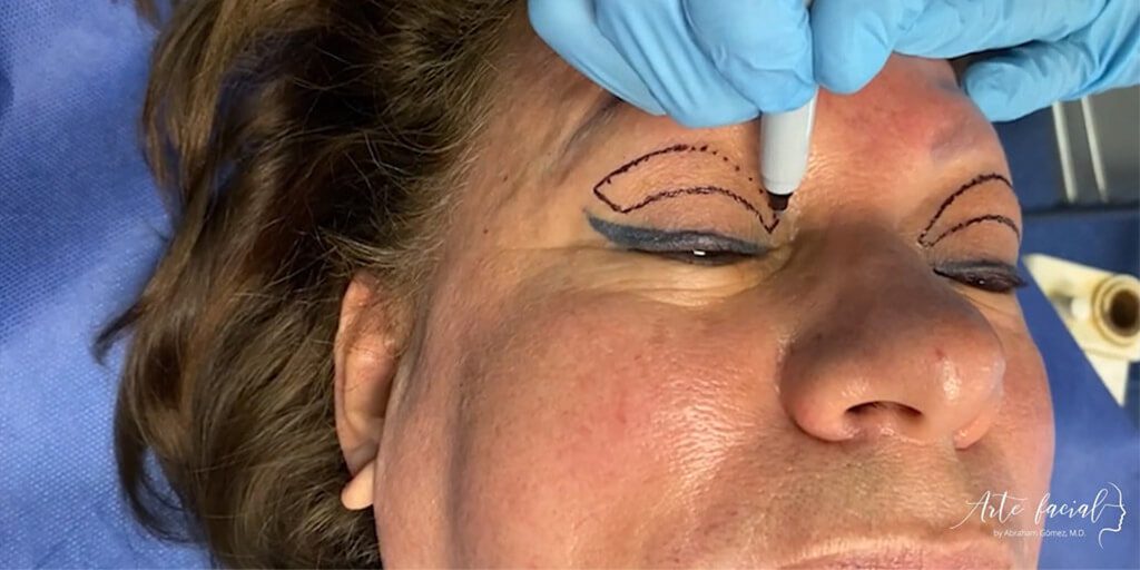 Blefaroplastia una cirugía para el levantamiento de párpados caídos Blefaroplastia una cirugía para el levantamiento de párpados caídos