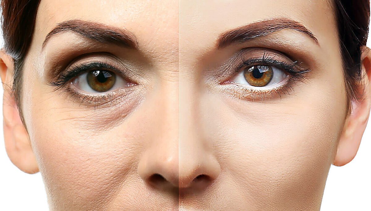 Cosmetic Lower Eyelid Surgery