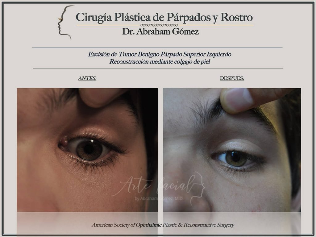 Tumor parpado
