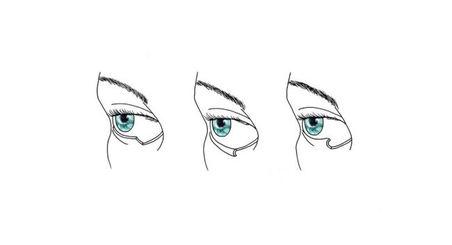 Entropion Ectropion service