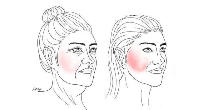 Facelift & Mini Facelift - Lifting Facial & Minilifting Facial - levantamiento de cara