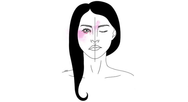 Facial palsy - Tratamiento de la parálisis facial