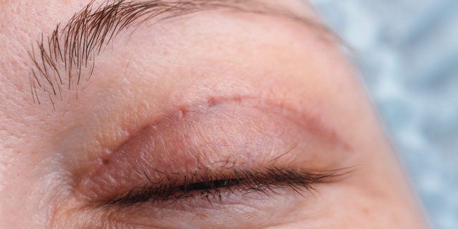 Causas de cicatrices en los párpados