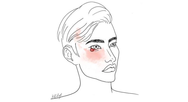 Diagnosis & treatment of eyelid cancer gallery - Diagnóstico y Tratamiento del Cáncer de Párpado - Tratamiento de cáncer de párpado