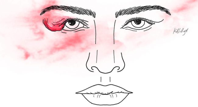 Lacrimal Gland Tumors - tratamiento de tumores de la glándula lagrimal