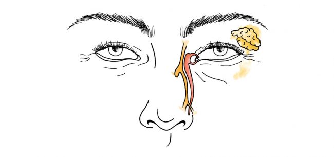 Treatment of Tear Duct Obstruction - Tratamiento de la Obstrucción del Conducto Lagrimal - tratamiento de obstrucción del conducto lagrimal