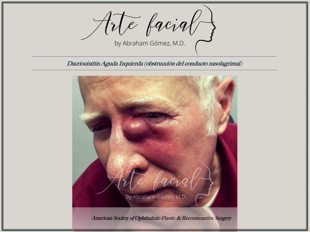 Acute dacryocystitis - Dacriocistitis aguda