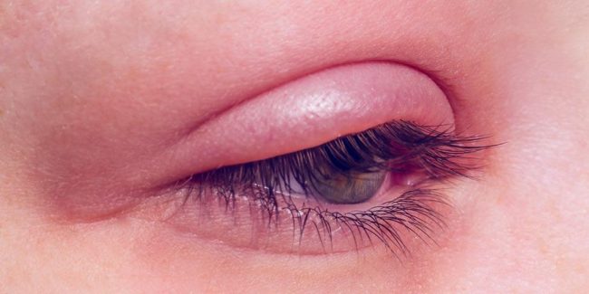Tratamiento para párpados inflamados - Treatments for puffy eyelids