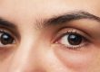 Complicaciones de la cirugía para eliminar bolsas (blefaroplastia) y cómo tratarlas - Complications of lower eyelid surgery and how to treat them