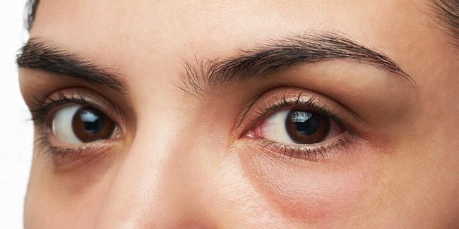 Complicaciones de la cirugía para eliminar bolsas (blefaroplastia) y cómo tratarlas - Complications of lower eyelid surgery and how to treat them
