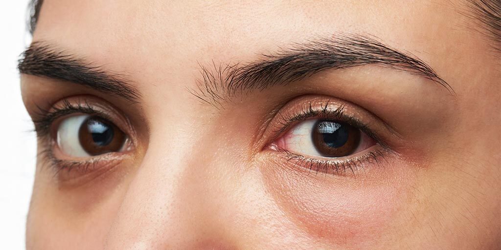 Complicaciones de la cirugía para eliminar bolsas (blefaroplastia) y cómo tratarlas - Complications of lower eyelid surgery and how to treat them