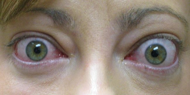 Tratamiento de la afectación ocular en el hipertiroidismo - Treatment of Thyroid Eye Disease