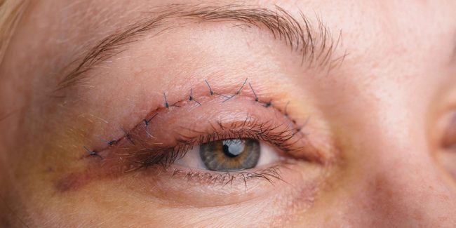 Qué sucede cuando hay complicaciones en la cirugía plástica de párpados