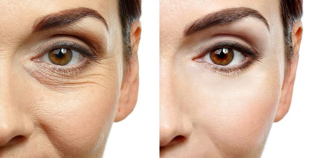 Cuál es la mejor manera de tratar las arrugas de los párpados - What’s the best way to treat eyelid wrinkles