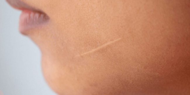 Tratamiento para cicatrices en la cara y los párpados - How to treat eyelid and facial scars