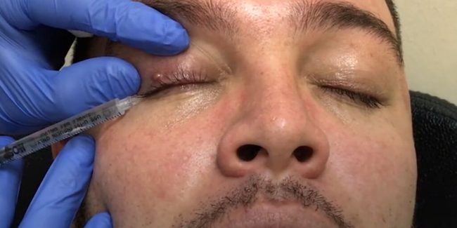 ¿Cuál es la mejor manera de quitar un tumor benigno alrededor de los ojos? - cysts and benign tumors around the eyes