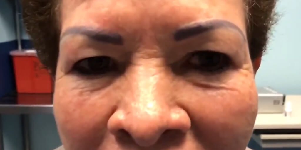 Levantamiento de párpados con anestesia local