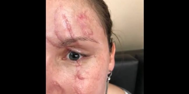 Uso de injertos de piel para la corrección de cicatrices en los párpados