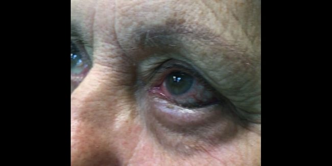 Tratamiento para pestañas invertidas