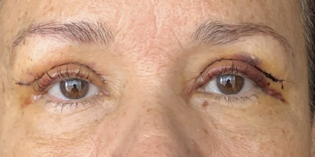 Recovery after eyelid plastic surgery