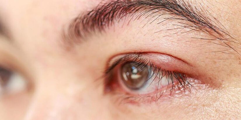 Cómo se trata un chalazion del párpado
