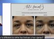 Cirugía de bolsas y ojeras - Webinar con el Dr Gómez