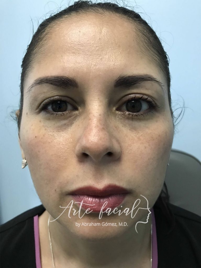 Test Fenilefrina 5 min después