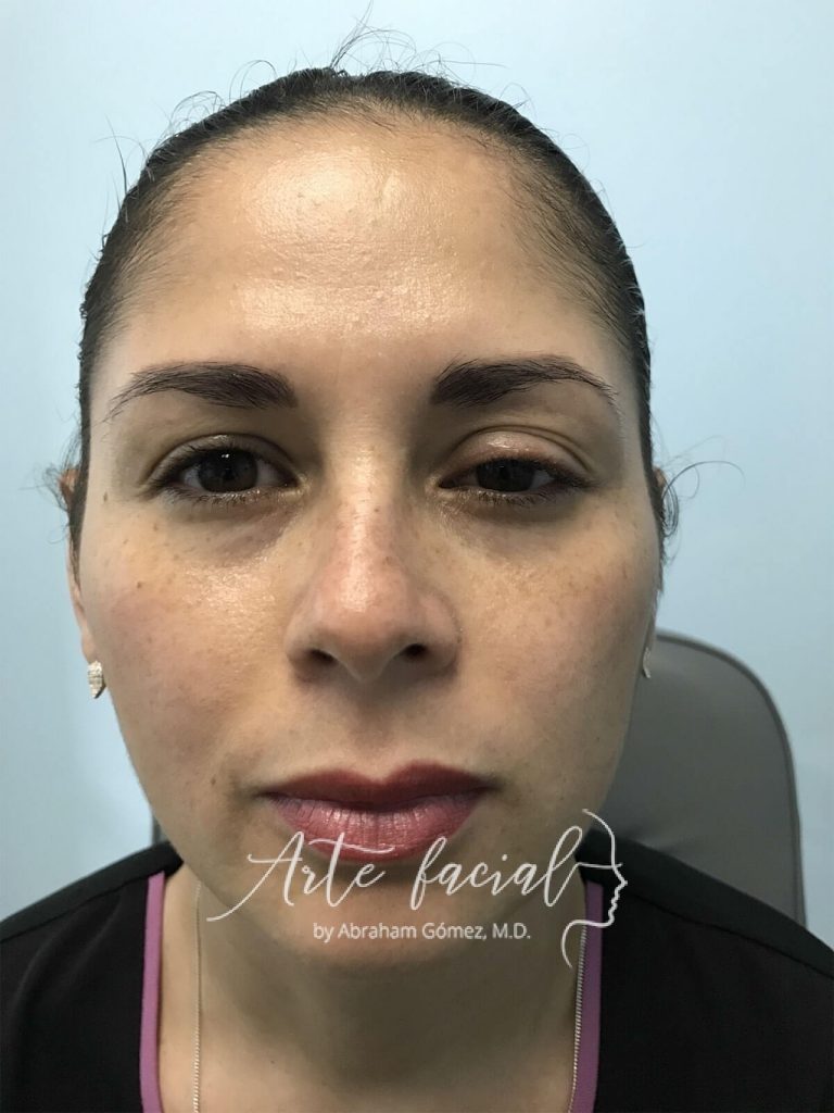 Test Fenilefrina antes