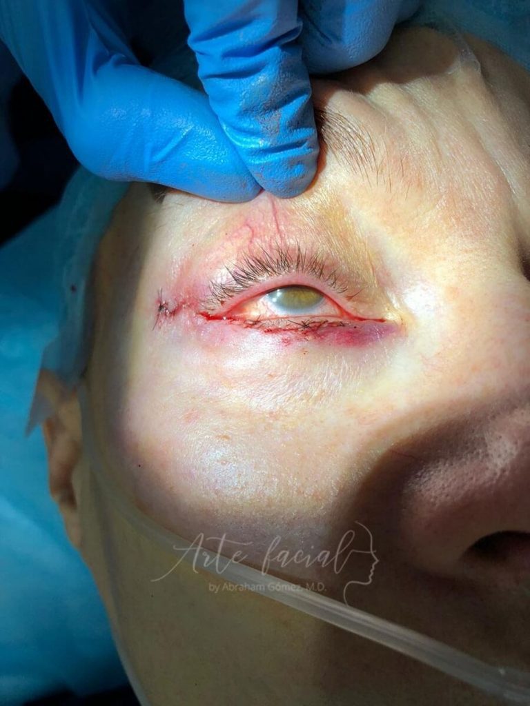 Eyelid reconstruction II